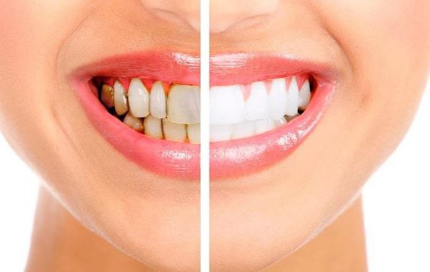 How Of Doing A Celebrity Teeth Whitening Procedure Inexepensively